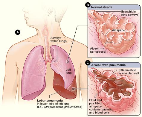 Natural remedies for Pneumonia