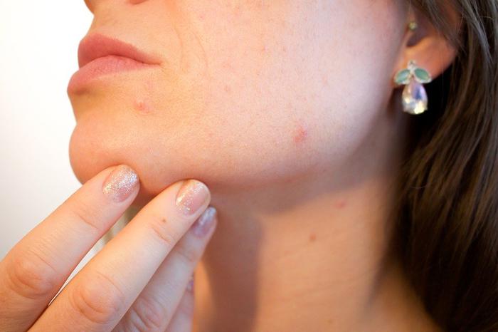 Easy ways to get rid of red spots on skin