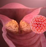 M-Strip: A simple innovation for early cervical cancer detection M-Strip: A simple innovation for early cervical cancer detection