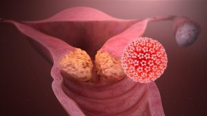 M-Strip: A simple innovation for early cervical cancer detection